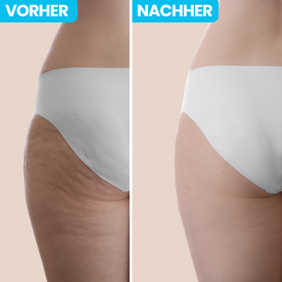 3 Tipps um Cellulite zu bekämpfen