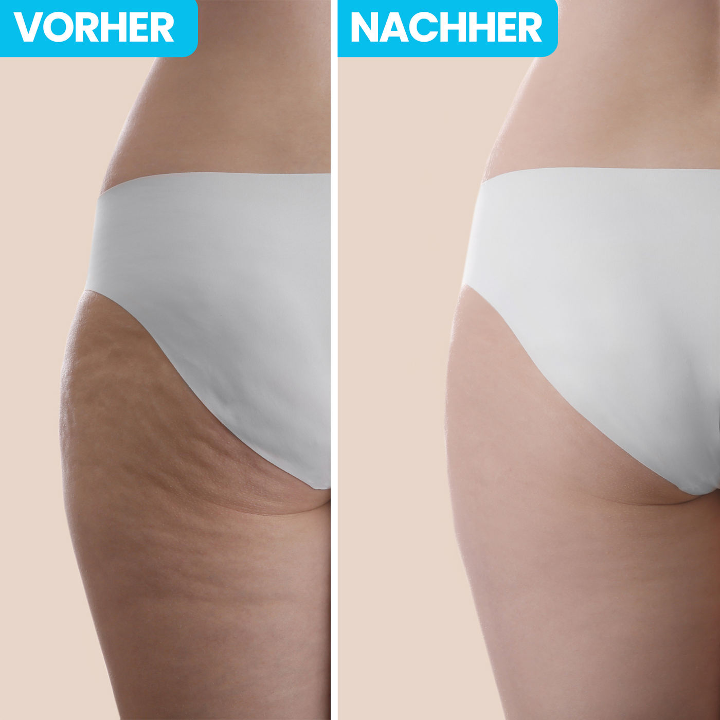 Anti-Cellulite mit Infrarotstrahlung